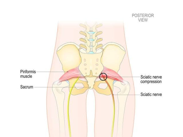 How to get rid of sciatica