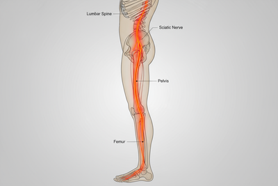 Can a Saddle Chair Be Your Ally Against Sciatica Pain?